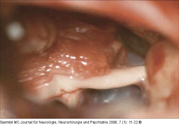 Operationssitus - Nervus trigeminus - Arteria  cerebelli superior
