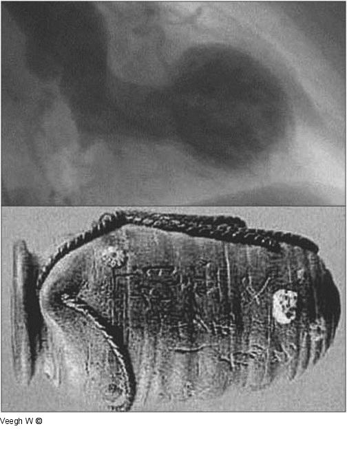 Ventrikulographie - Tako-Tsubo