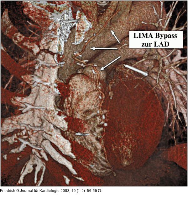 LIMA-Bypass zur LAD