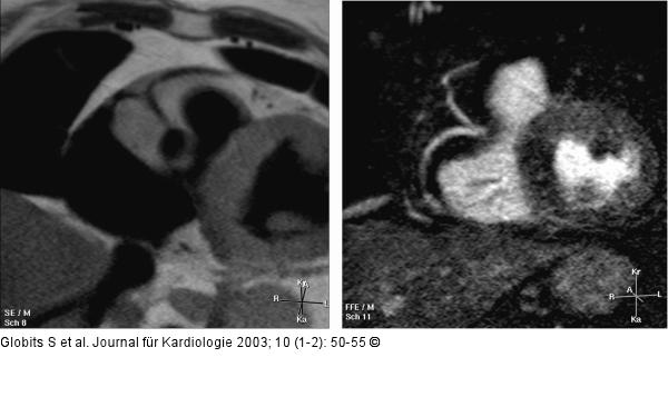 Kardiale Magnetresonanztomographie