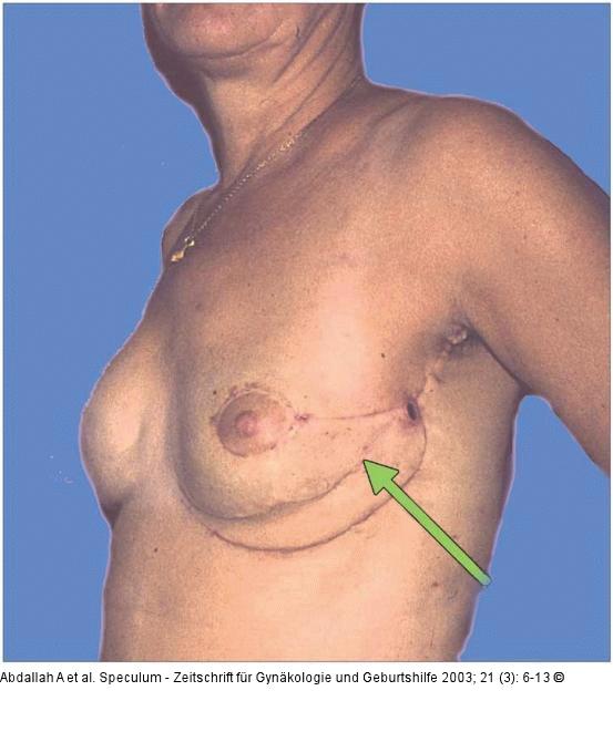 Brusterhaltung - Kosmetische Chirurgie