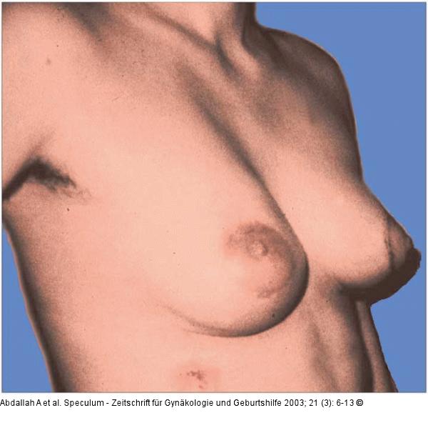 Brusterhaltung - Kosmetische Chirurgie