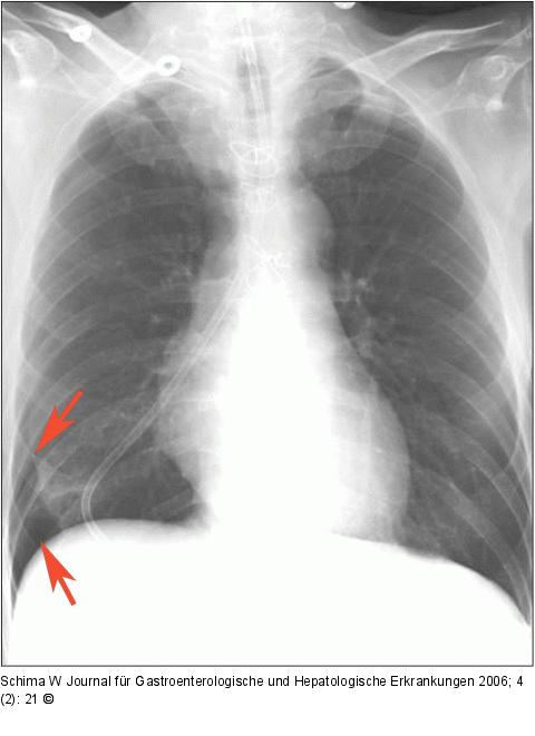 Magensonde - Fehllage