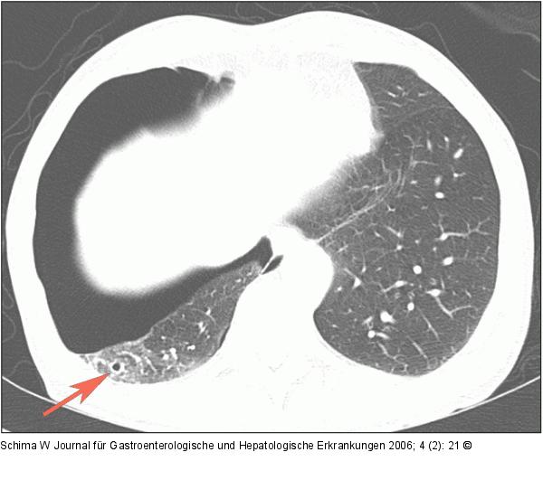 Pneumothorax