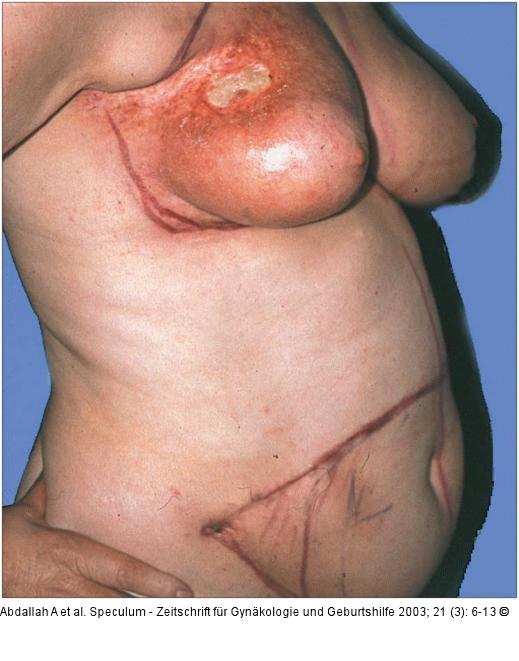 Brusterhaltung - Kosmetische Chirurgie