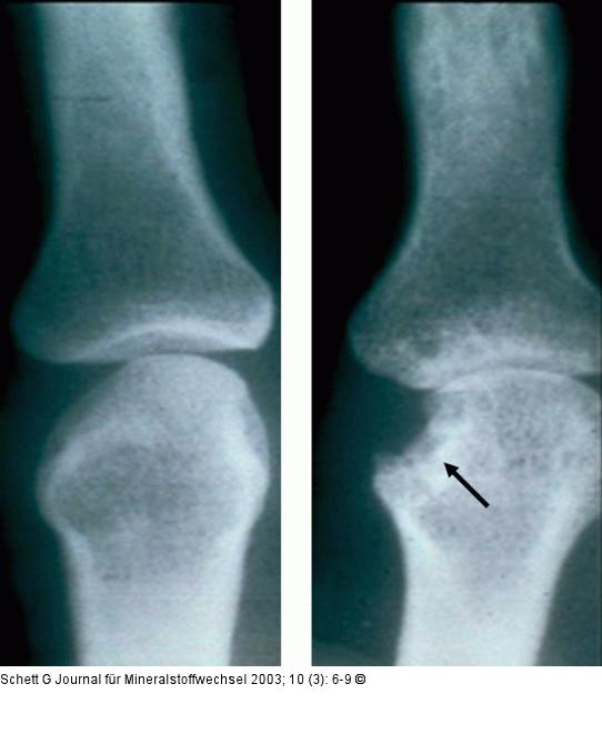 Rheumatoide Arthritis - Knochenerosion