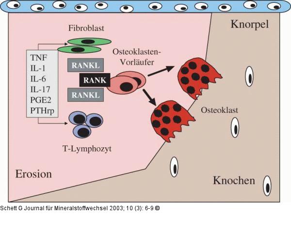 Rheumatoide Arthritis - Knochenerosion