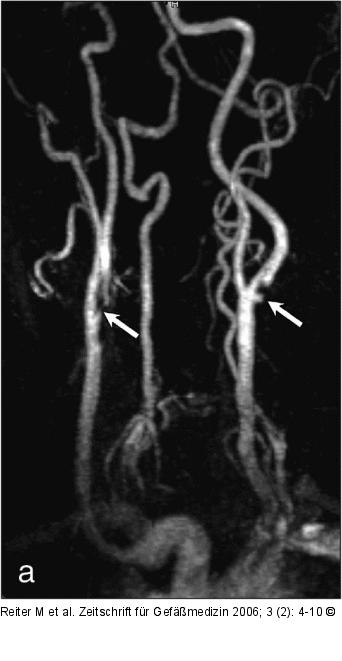 Arteria carotis interna