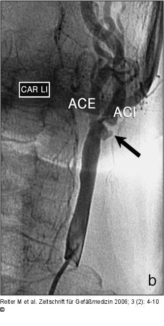 Arteria carotis interna