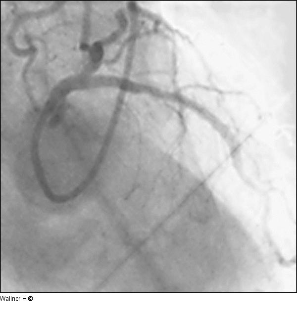 Kissing-Ballon - Mid-LAD-Stent