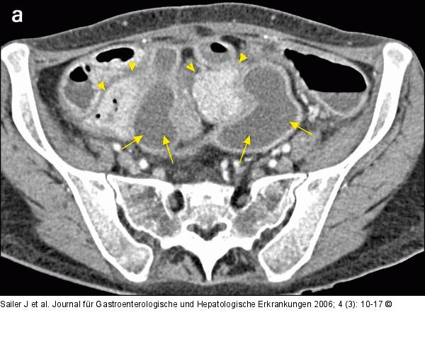 CT-Enteroklysma