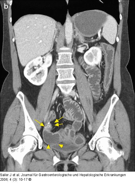 Morbus Crohn-Rezidiv