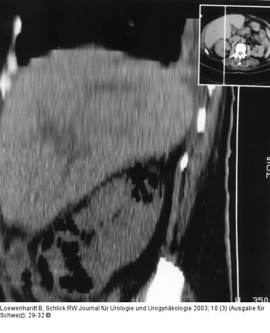 Emphysematöse Pyelonephritis