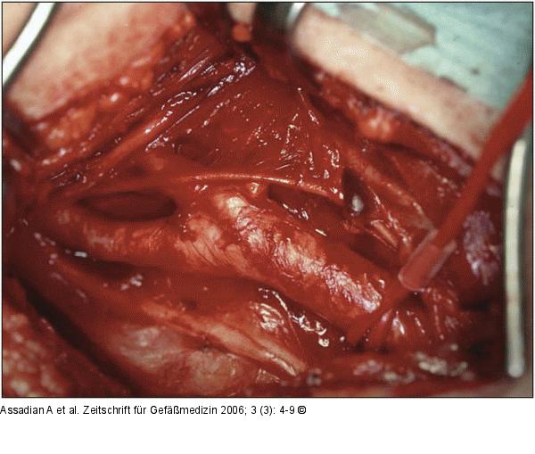 Arteria carotis communis