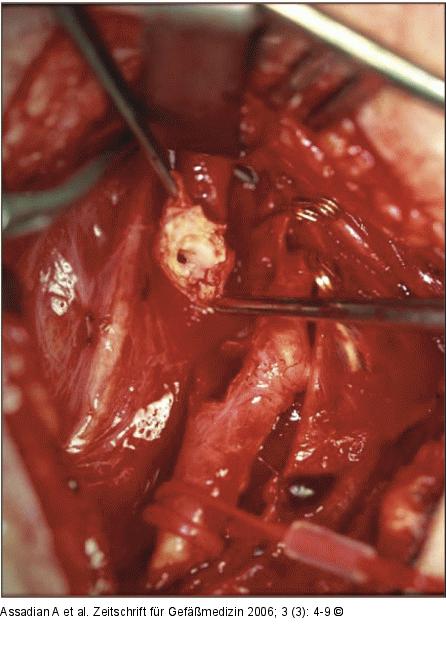 Arteria carotis communis