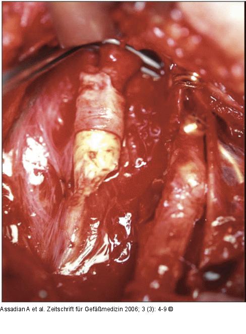 Arteria carotis communis