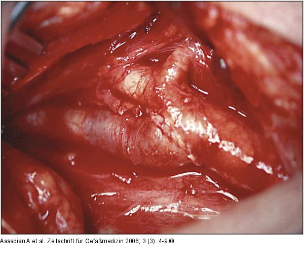 Arteria carotis communis