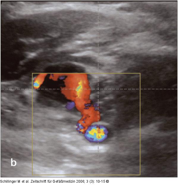 Arteria carotis communis - Vena jugularis interna