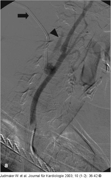 Arteria carotis communis