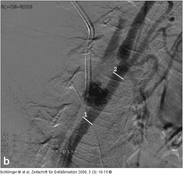 Arteria carotis communis