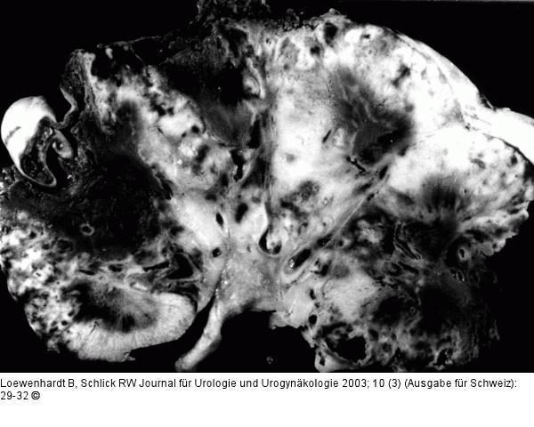 Emphysematöse Pyelonephritis