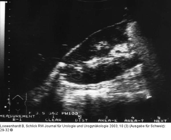 Emphysematöse Pyelonephritis