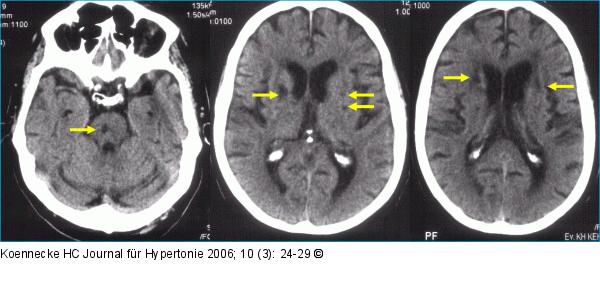 Zerebrale Mikroangiopathie - Arterielle Hypertonie