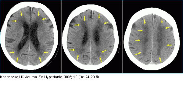 Zerebrale Mikroangiopathie - Arterielle Hypertonie
