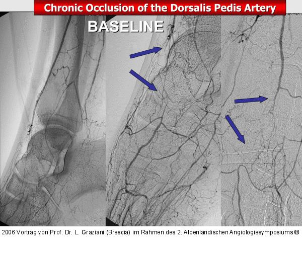 Arteria dorsalis pedis