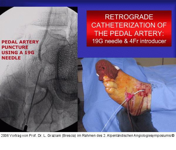 Arteria dorsalis pedis - Katheterisation