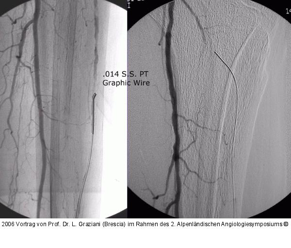 Arteria dorsalis pedis - Katheterisation