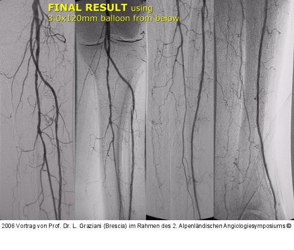 Arteria dorsalis pedis - Katheterisation