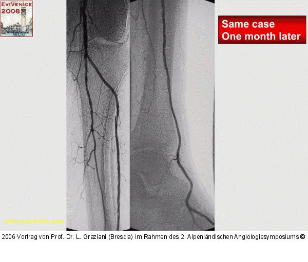 Arteria dorsalis pedis - Katheterisation
