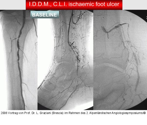 Arteria dorsalis pedis - Katheterisation