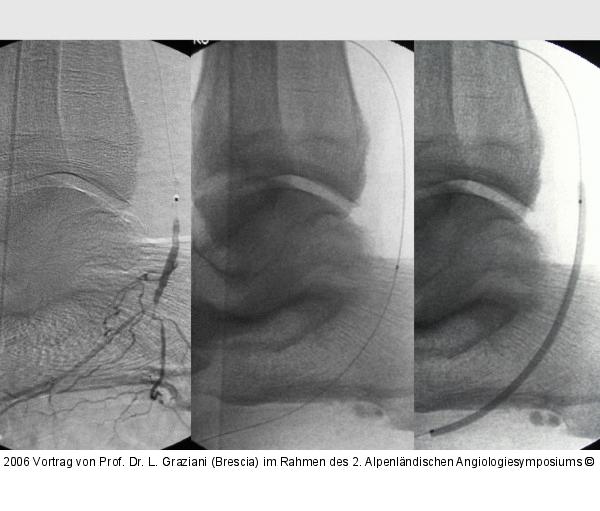 Arteria dorsalis pedis - Katheterisation