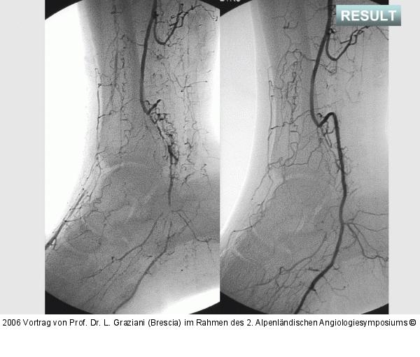 Arteria dorsalis pedis - Katheterisation
