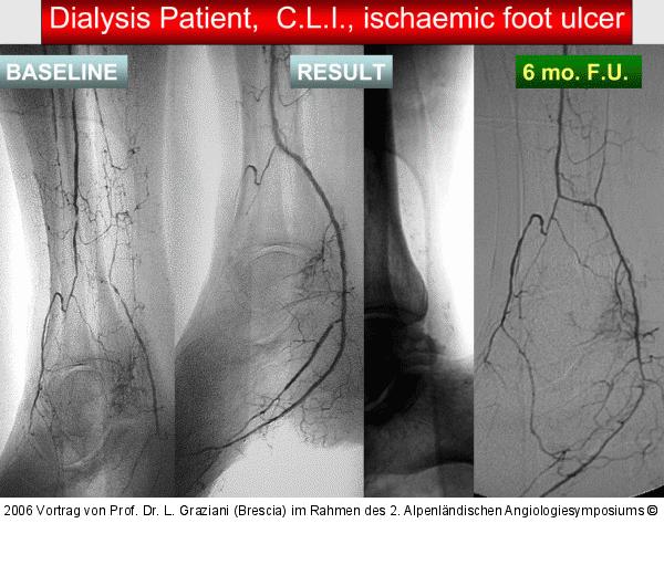 Arteria dorsalis pedis - Katheterisation