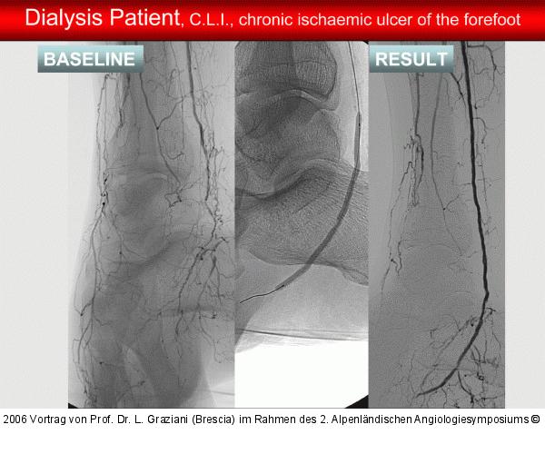 Arteria dorsalis pedis - Katheterisation