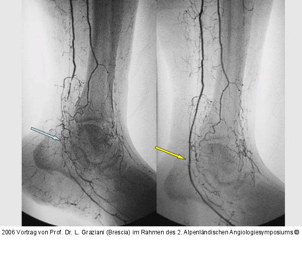 Arteria dorsalis pedis - Katheterisation
