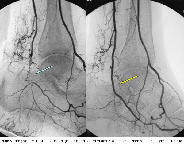 Arteria dorsalis pedis - Katheterisation