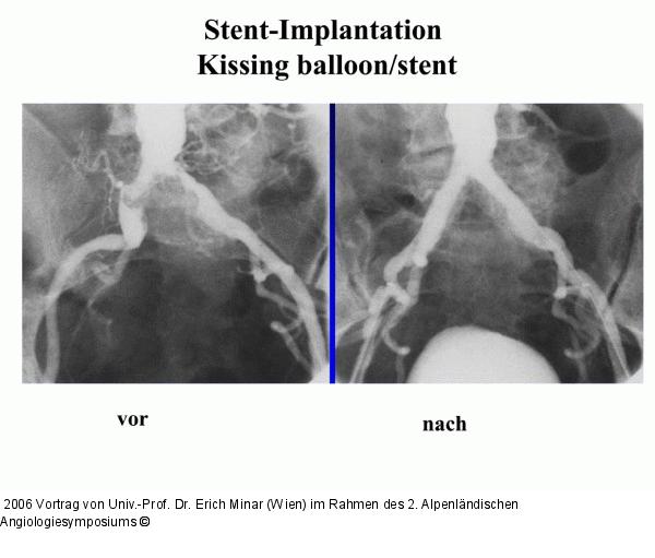 Stent-Implantation