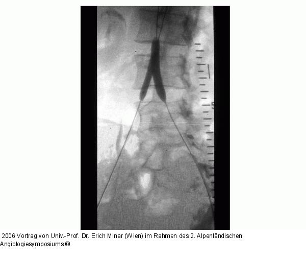 Stent-Implantation