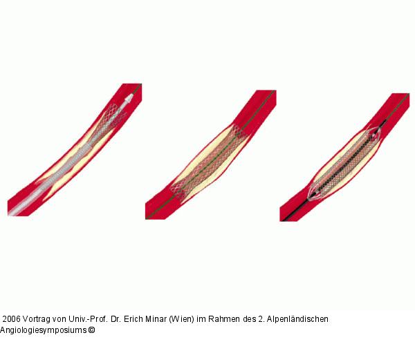 Stent
