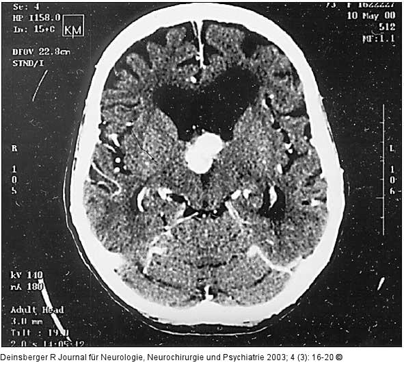 Hypernephrom-Metastase