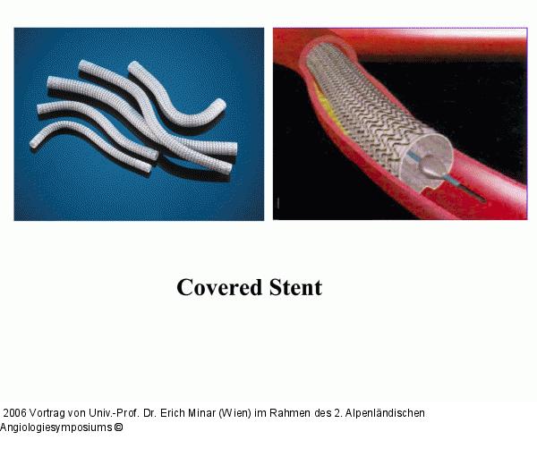 Covered Stent