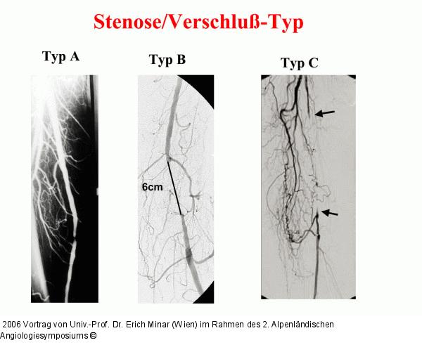 Stenose/Verschluß-Typ