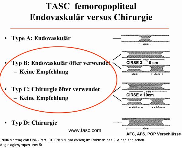TASC femoropopliteal
