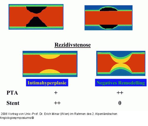 Rezidivstenose
