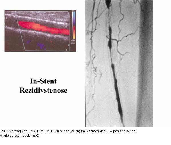 In-Stent Rezidivstenose