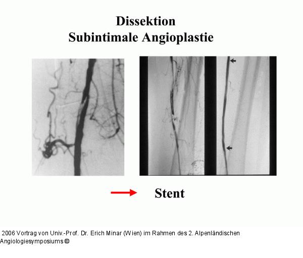Stentimplantation